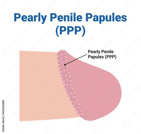 papule perlee penis|PPP: Pearly Penile Papules Facts and Treatment